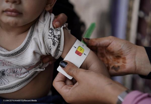 تقرير أممي: حرمان ربع مليون يمني من علاج سوء التغذية الحاد